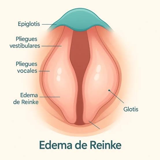Ilustración de edema de Reinke